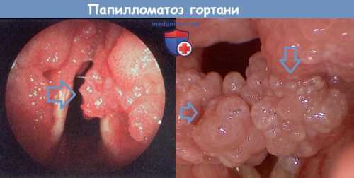 Осложнения и последствия