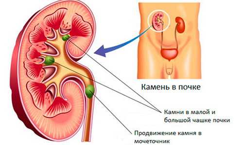 Профилактика образования камней в почках