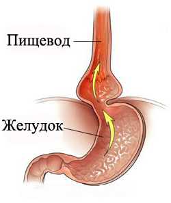 Диагностика такого патологического состояния, как рефлюкс, является неотъемлемой частью выбора успешного лечения и включает, прежде всего, сбор информации относительно беспокоящей симптоматики, ее продолжительности, сопутствующих факторов и особенностей ежедневного питания