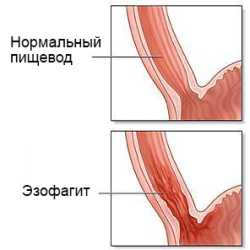 Эзофагит: симптомы, причины, это заболевание