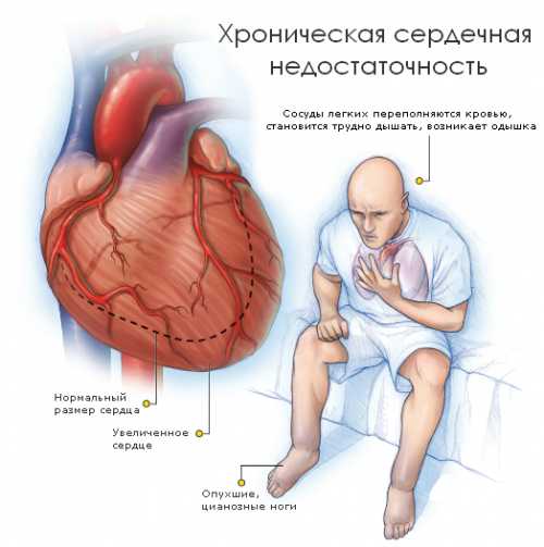 При этом развивается острый отёк лёгких, который проявляется следующими признаками