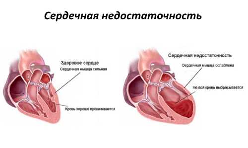 Третья степень не поддается полному лечению, так как ее механизм уже полностью запущен